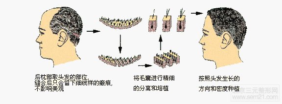 FUT单体毛囊植发术