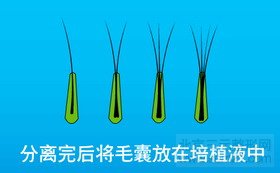 FUT单体毛囊植发第五步