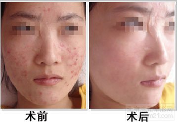 射频调节痤疮前后对比图