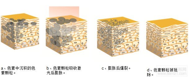 E光调节太田痣解说图
