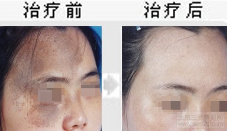 E光调节太田痣对比图