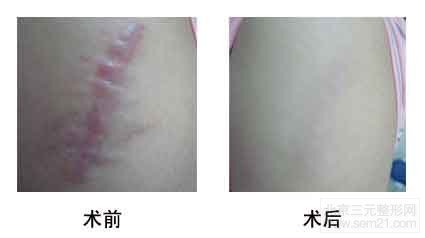 激光调节瘢痕前后对比图