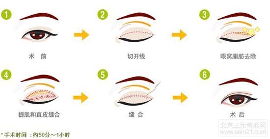 双眼皮切割