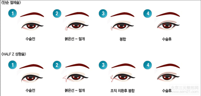韩国开眼角