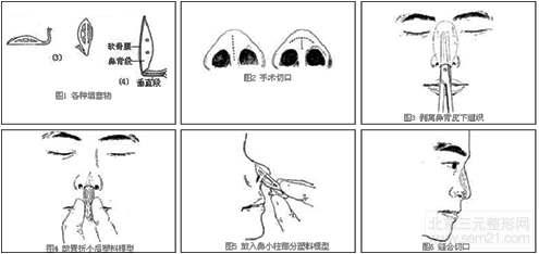 矮鼻矫正