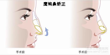 鹰钩鼻矫正