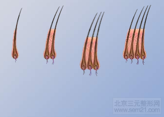 毛发移植示意图2