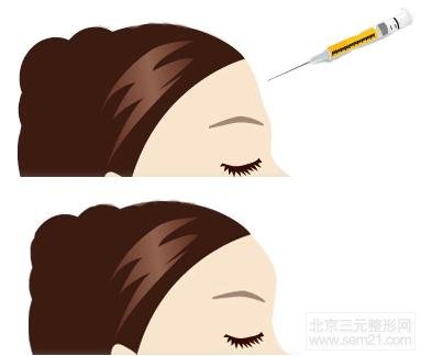额头填充案例图