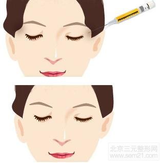 太阳穴填充案例图