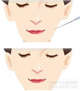 面颊填充案例图