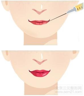 丰唇示意图