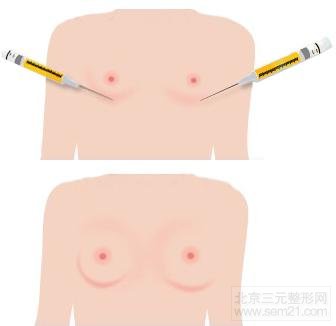 隆胸示意图