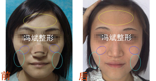 北京东方和谐冯斌整形案例