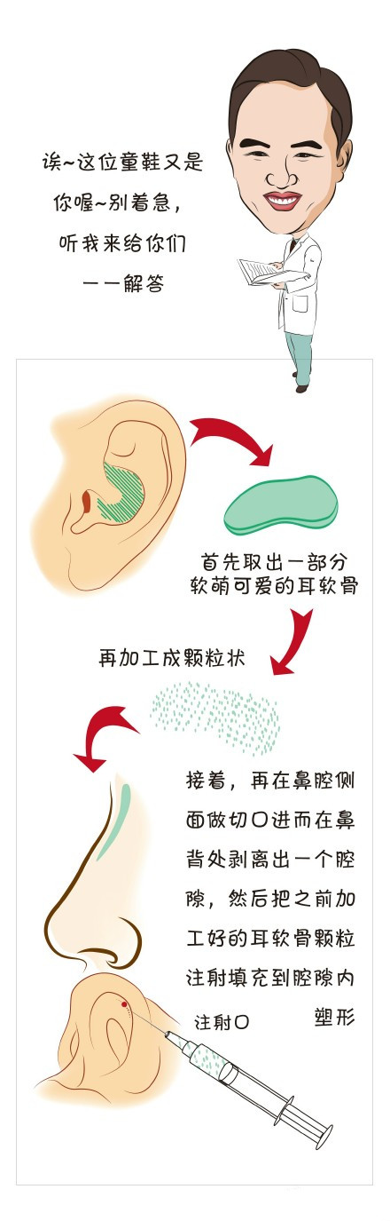 颗粒注射隆鼻