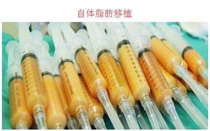 自体脂肪整形 自体脂肪整形