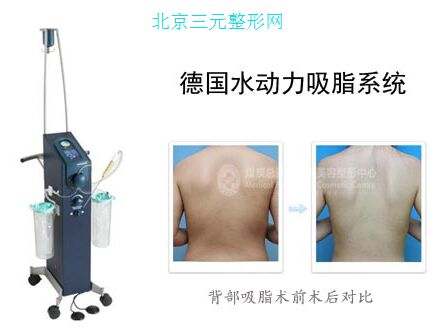 德国水动力设备和吸脂案例 德国水动力设备和吸脂案例