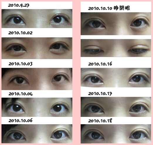 双眼皮案例 双眼皮案例
