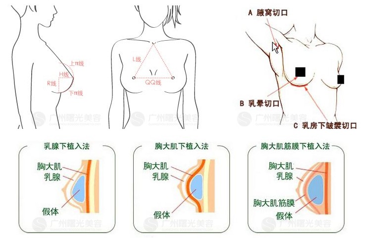 假体隆胸切口的选择 假体隆胸切口的选择