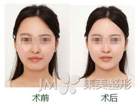 郑州集美玻尿酸填充下班案例 郑州集美玻尿酸填充下班案例