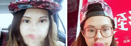 双眼皮案例 双眼皮案例