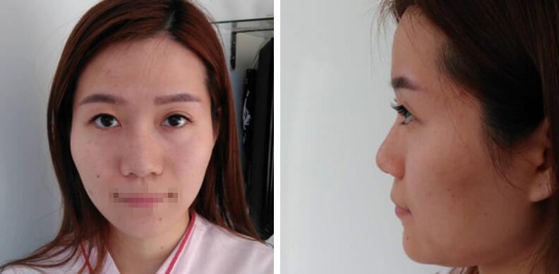 自体脂肪填充额头案例 自体脂肪填充额头案例