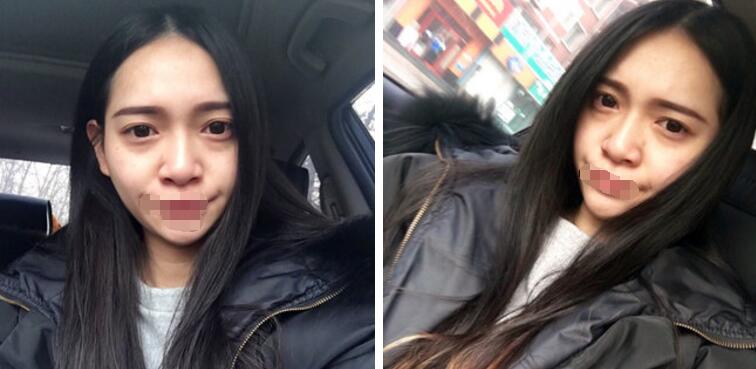 去眼袋案例图 去眼袋案例图