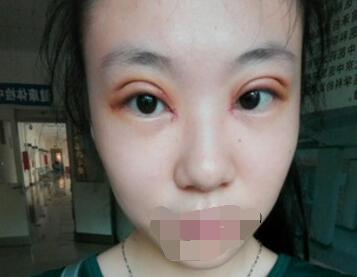 双眼皮案例日记 双眼皮案例日记