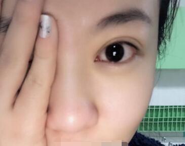 双眼皮案例日记 双眼皮案例日记