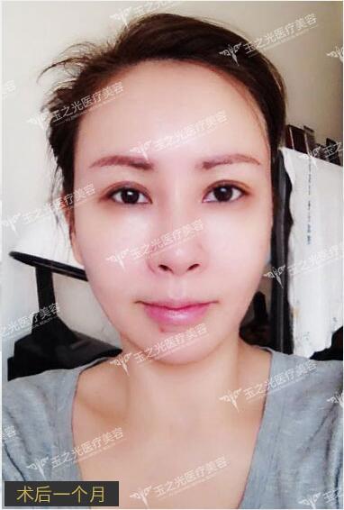 北京玉之光脂肪填充案例 北京玉之光脂肪填充案例