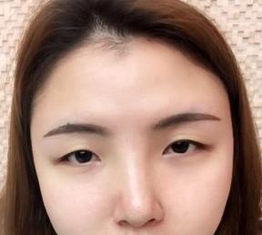 双眼皮案例分享 双眼皮案例分享