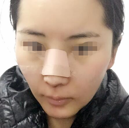 奥美定取出 奥美定取出