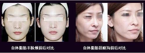 自体脂肪填充 自体脂肪填充