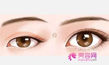 成都军大,双眼皮,怎么样?价格案例分享