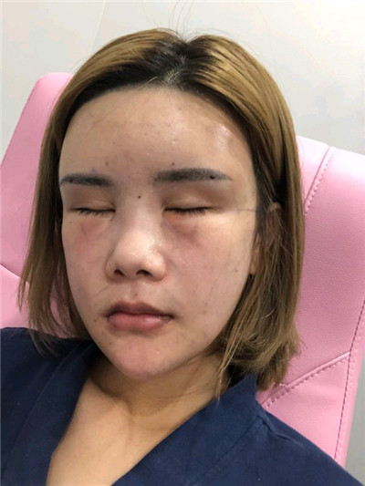 重庆铂生,杜亚旭,面部填充,案例,价格,