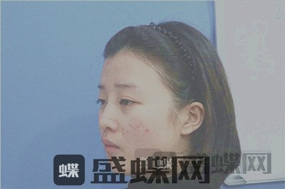 杭州格莱美,张龙,鼻部手术,案例,价格,