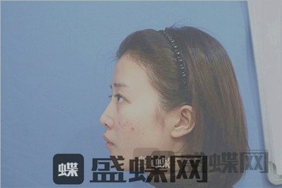 杭州格莱美,张龙,鼻部手术,案例,价格,