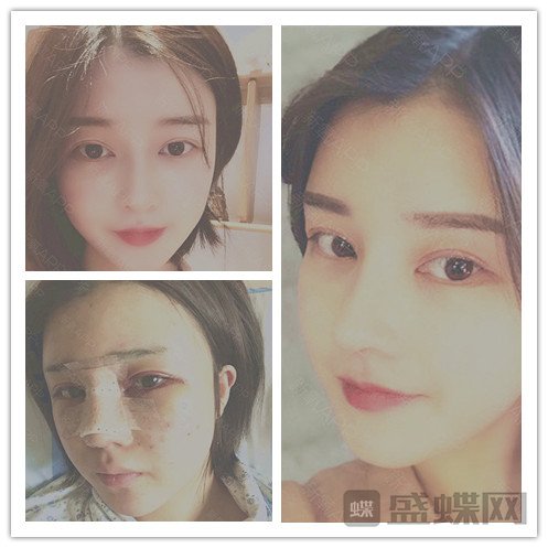 杭州格莱美,张龙,鼻部手术,案例,价格,