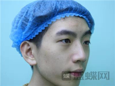 上海九院,王维,眼部手术,案例,价格,