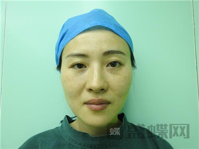 北京百达丽,苏婷,眼部手术,案例,价格,