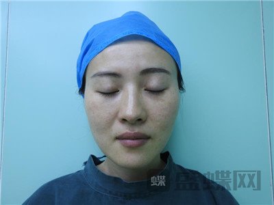 北京百达丽,苏婷,眼部手术,案例,价格,