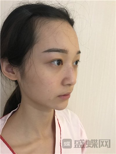 上海百达丽,沈国雄,隆鼻,案例,价格,