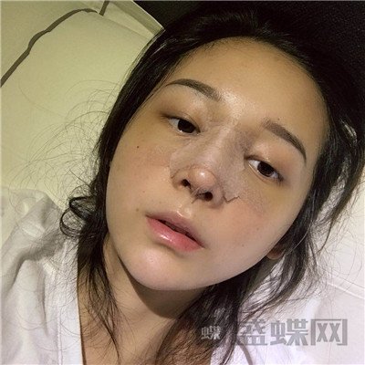 上海百达丽,沈国雄,隆鼻,案例,价格,