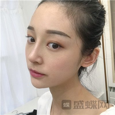 上海百达丽,沈国雄,隆鼻,案例,价格,