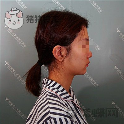 北京润美玉之光,王明利,面部填充,案例,价格,