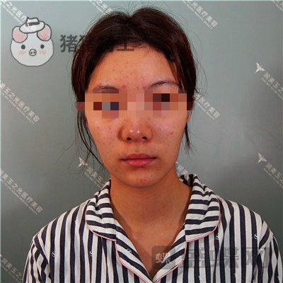 北京润美玉之光,王明利,面部填充,案例,价格,
