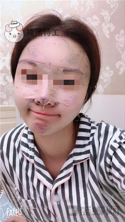 北京润美玉之光,王明利,面部填充,案例,价格,