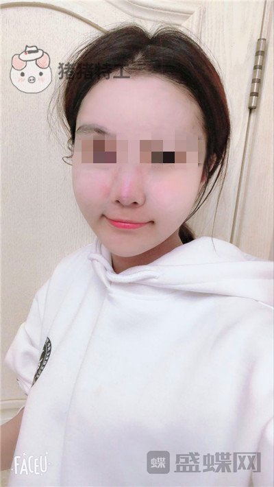 北京润美玉之光,王明利,面部填充,案例,价格,