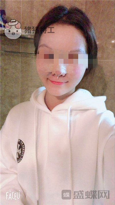 北京润美玉之光,王明利,面部填充,案例,价格,