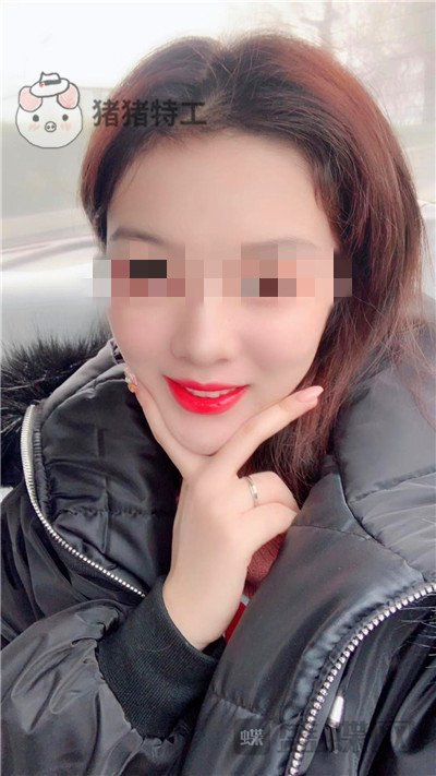 北京润美玉之光,王明利,面部填充,案例,价格,