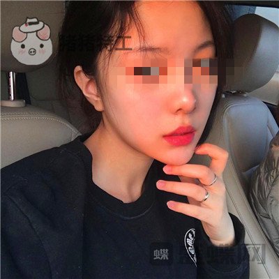 北京润美玉之光,王明利,面部填充,案例,价格,